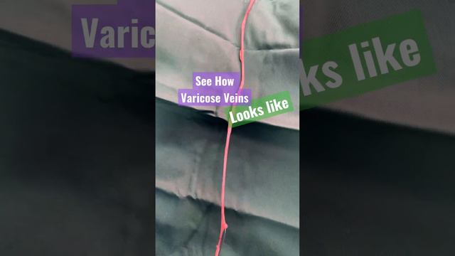 See Varicose Veins - LIVE Real Varicose veins Looks like смотреть онлайн