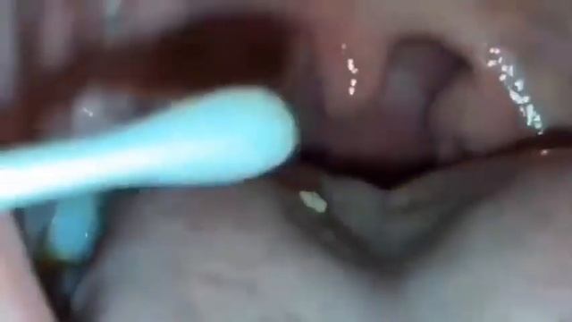 Удаление гнойных пробок из небных миндалин?