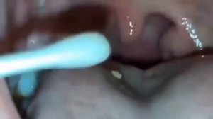 Удаление гнойных пробок из небных миндалин?