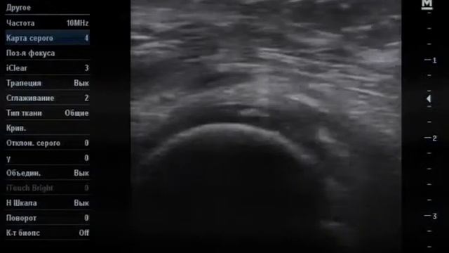 Хондрокальциноз гиалинового хряща смотреть онлайн