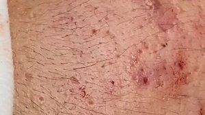 Relaxing Spa Очищение кожи Удаление прыщей 1 #relaxing #spa