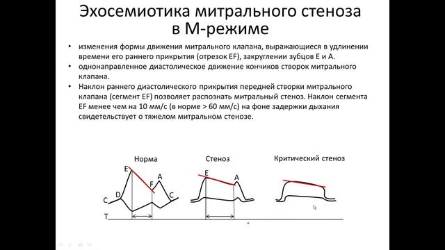 ОСНОВЫ ЭХОКАРДИОГРАФИИ  Митральный стеноз