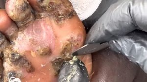 Dejiggering Samson the crybaby's HEAVY JIGGERS  - - to watch full video @riseupsociety.net