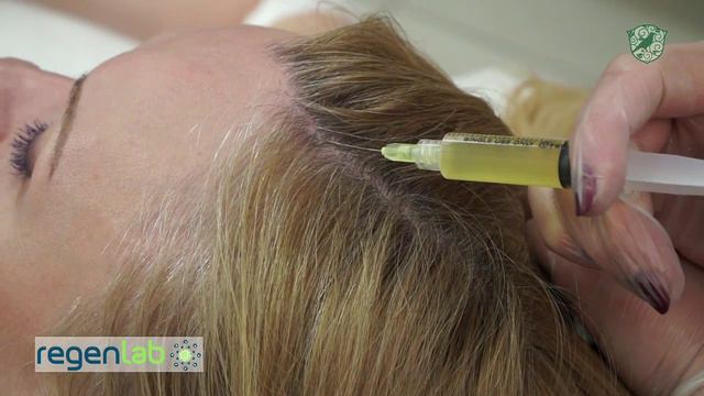 Аутологичное клеточное омоложение кожи головы.  Regenlab