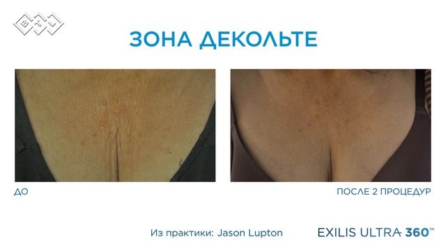 Презентация аппарата для RF-лифтинга BTL Exilis Ultra 360 смотреть онлайн