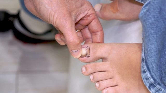 Diagnosing Nail Melanoma. смотреть онлайн
