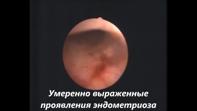 Гистероскопия у девственницы? Реально! (видео для врачей) смотреть онлайн