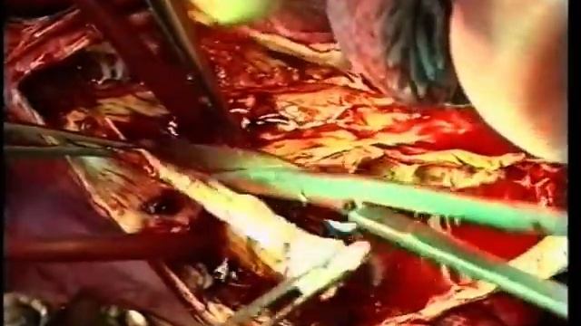 Протезирование торакоабдоминальной аорты при расслаивающей аневризме, 2002