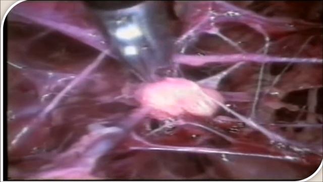 Axillary Lymph Node Resection and Thyroidectomy - Lecture by Dr R K Mishra смотреть онлайн