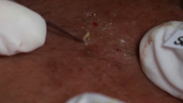 Relaxing Time Every Day with Sophia Skin Care, Acne, Blackheads #24 смотреть онлайн