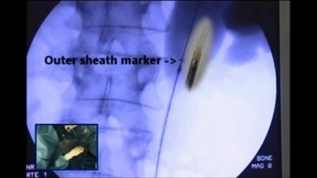 UVENTA™ Ureteral Stent - Procedure (Diffused Stricture) / UVENTA 요관 스텐트 / 輸尿管支架 / 尿管ステント смотреть онлайн