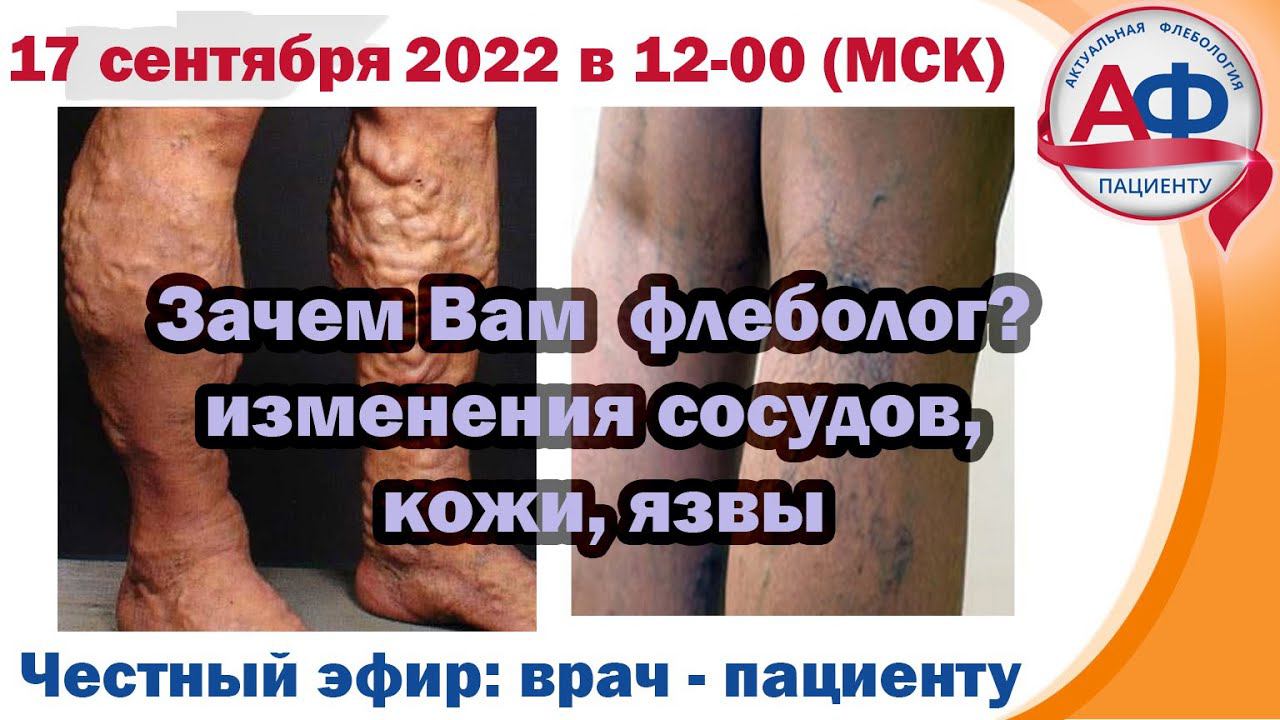 Вам нужен не флеболог! внешний вид сосудов, кожи, язв смотреть онлайн