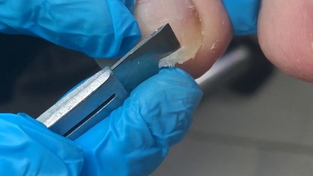 Cut long ingrown nails and get a professional pedicure!【Crazy pedicure room】 смотреть онлайн