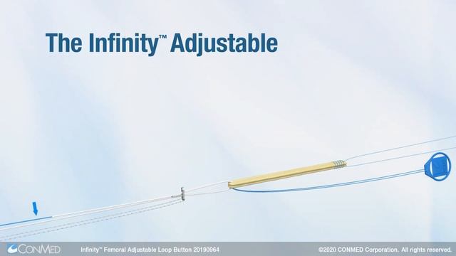 Infinity™ Femoral Adjustable Loop Button - CONMED Product Video смотреть онлайн
