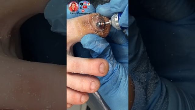 Упал диван - синяк под ногтем на ноге смотреть онлайн