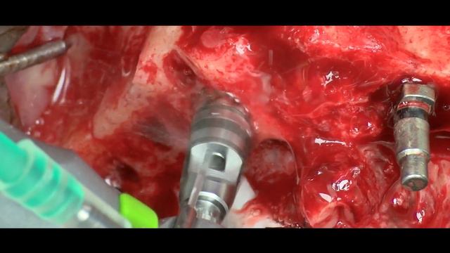PrimeTaper EV (Dentsply Sirona). Immediate loading edentulous maxilla and SmartFix. Dr. Toia Marco смотреть онлайн