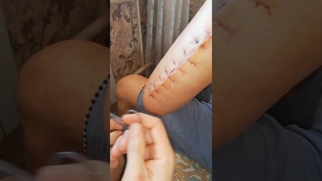 Как снять швы в домашних условиях. смотреть онлайн