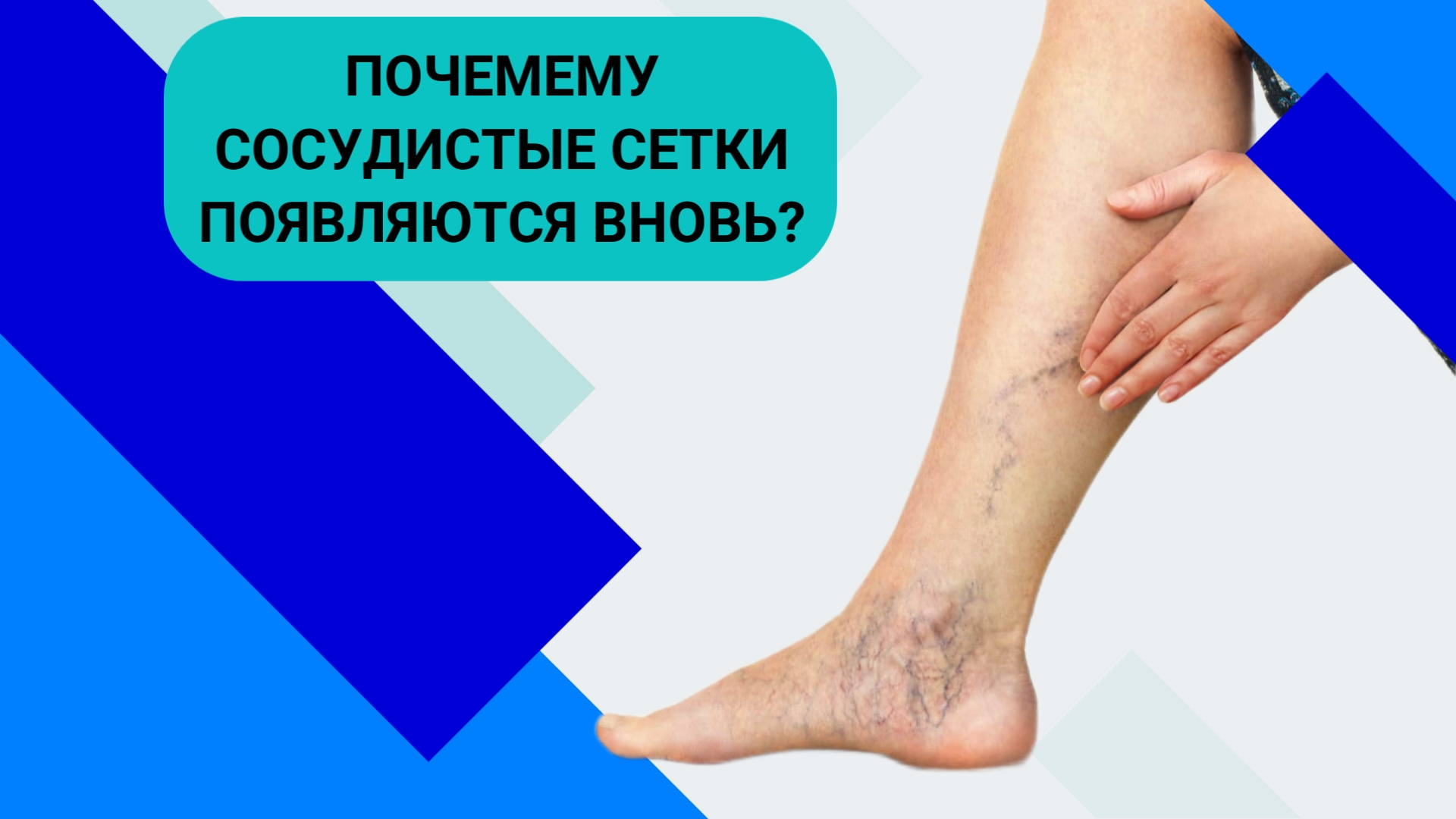 ПОЧЕМУ СОСУДИСТЫЕ СЕТКИ ПОЯВЛЯЮТСЯ ВНОВЬ? смотреть онлайн