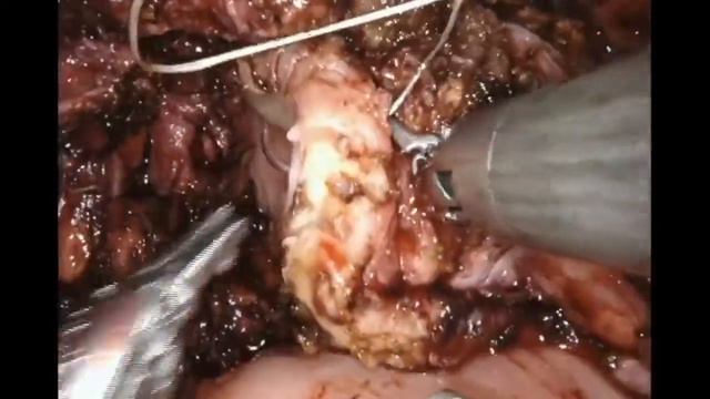 19.167 GYN - Robotic Assisted Laparoscopic Resection of Bladder and Ureteral Endometriosis смотреть онлайн