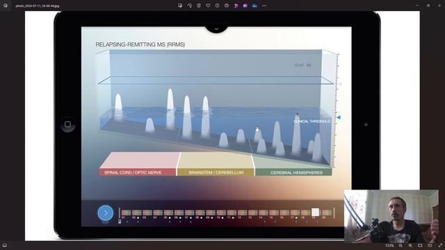 Как объяснить близким нейронную недостаточность  при рассеянном склерозе.