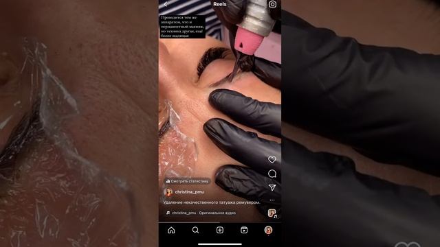 Удаление татуажа ремувером смотреть онлайн