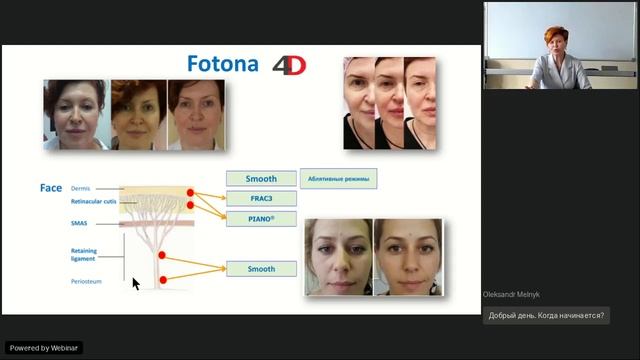Вебинар Fotona: Режим FotonaSmooth от прошлого к будущему смотреть онлайн