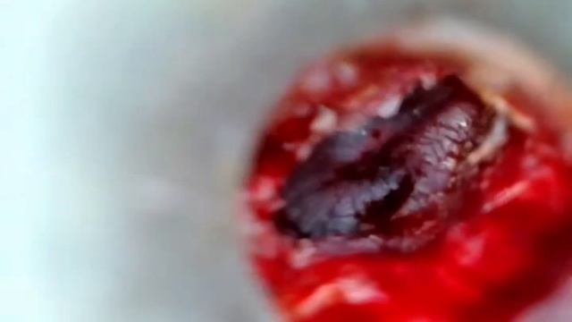 При стапедопластике все разрезы внутри уха. смотреть онлайн