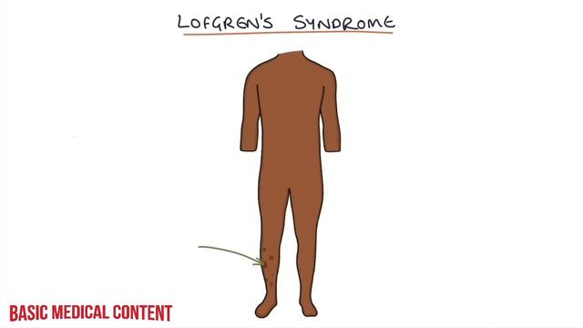 Sarcoidosis | Drk смотреть онлайн