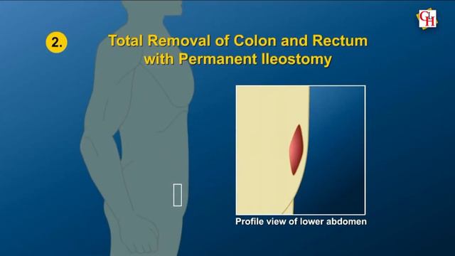 जानिये Ulcerative Colitis में सर्जरी की जरूरत क्यों होती है ? смотреть онлайн