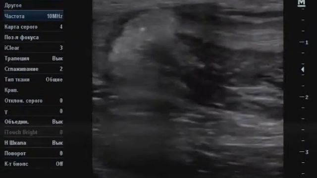 Неполное повреждение ахиллова сухожилия смотреть онлайн