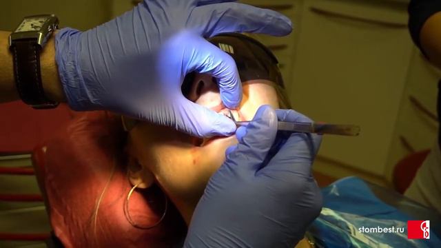 Как провести ретракцию десны , как снять оттиск смотреть онлайн