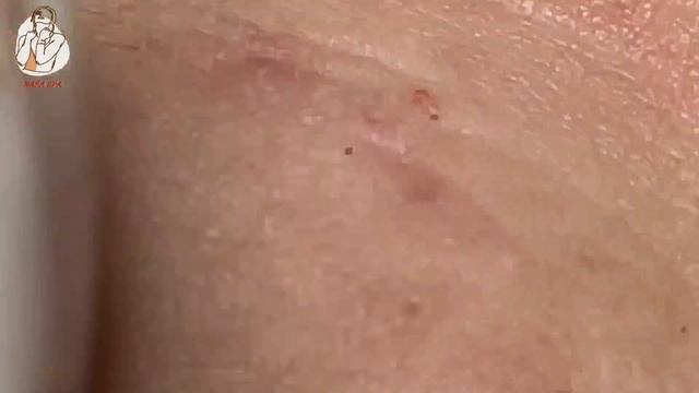 Remove Blackheads And Pimples Popping At HT Spa #18