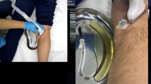 Пункция кисты БЕЙКЕРА под контролем УЗИ