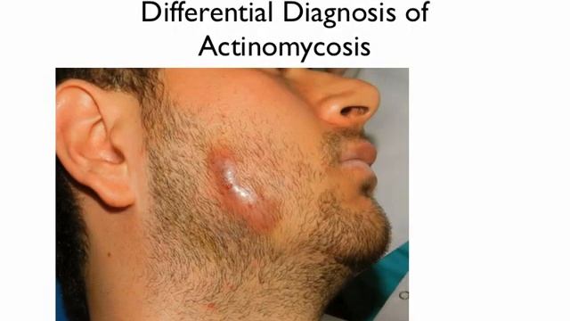 Medical Zone   Differential Diagnosis Of Actinomycosis