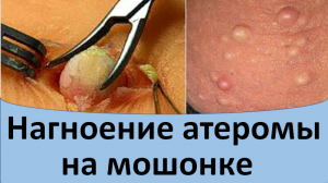 Нагноение атеромы на мошонке