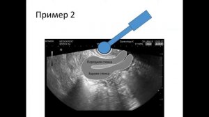 УЗИ органов малого таза: положения матки