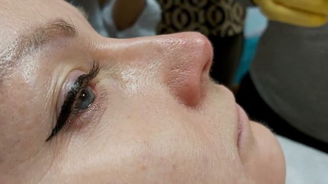 АирисКом студенты учатся: исправление кончика носа филлерами. смотреть онлайн