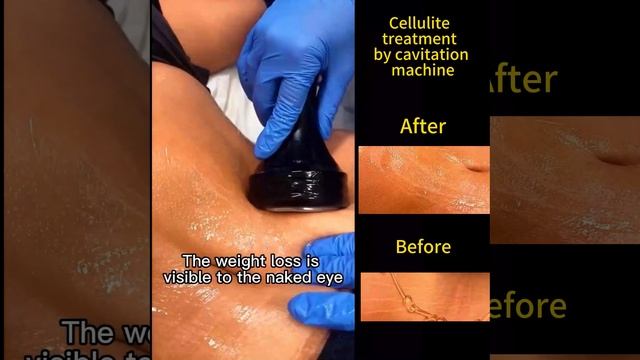 Say Goodbye to Cellulite: Effective Cellulite Treatment with Cavitation Machine смотреть онлайн