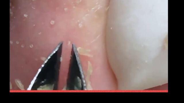 Shocking Cystic Blackheads & Whiteheads Extraction Revealed / New Blackheads This Week 5