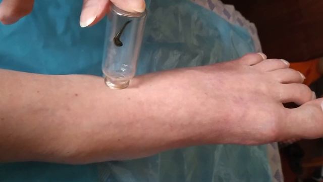 Гирудотерапия по-домашнему. Отек после снятия гипса. Голеностопный сустав