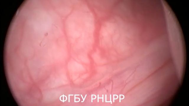 Установка мочеточникового катетер-стента.