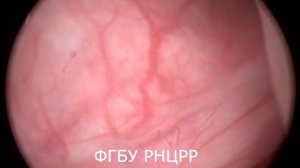 Установка мочеточникового катетер-стента.