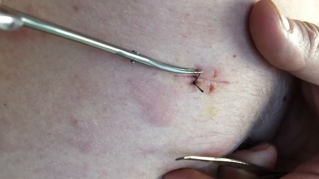 Учимся самостоятельно снимать хирургические швы смотреть онлайн