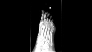 Укладка пальцев стопы