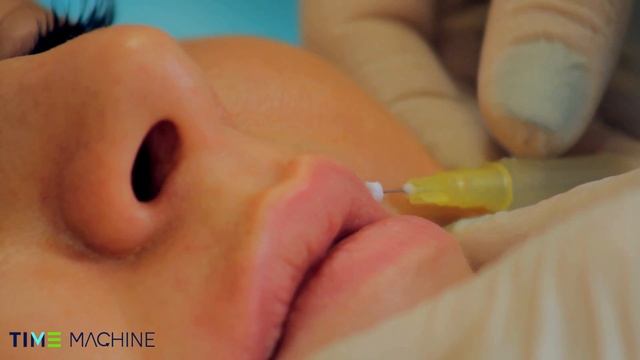 Тредлифтинг  периоральной области