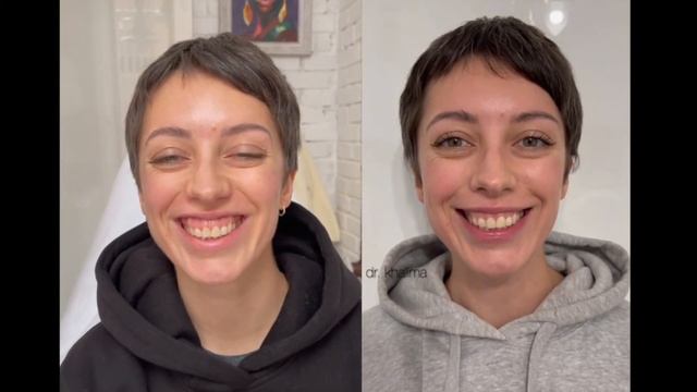 Коррекция десневой улыбки ? @ Dr.khalima