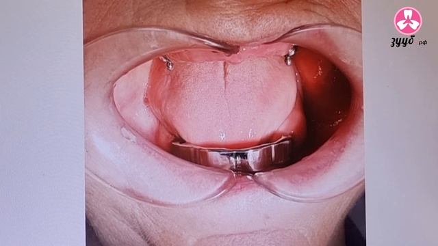 Протезирование на имплантах Nobel Biocare смотреть онлайн