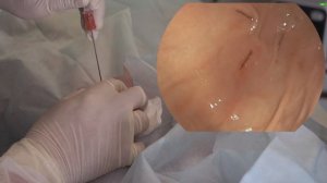 Установка низкопрофильной гастростомической трубки по методике прямой пункционной гастростомии