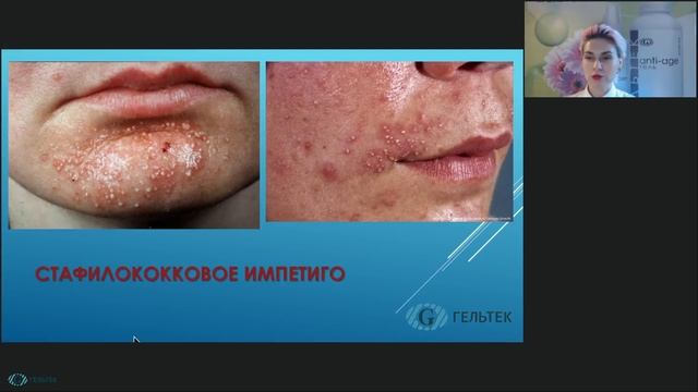 Такая разная сыпь: давайте разбираться! смотреть онлайн