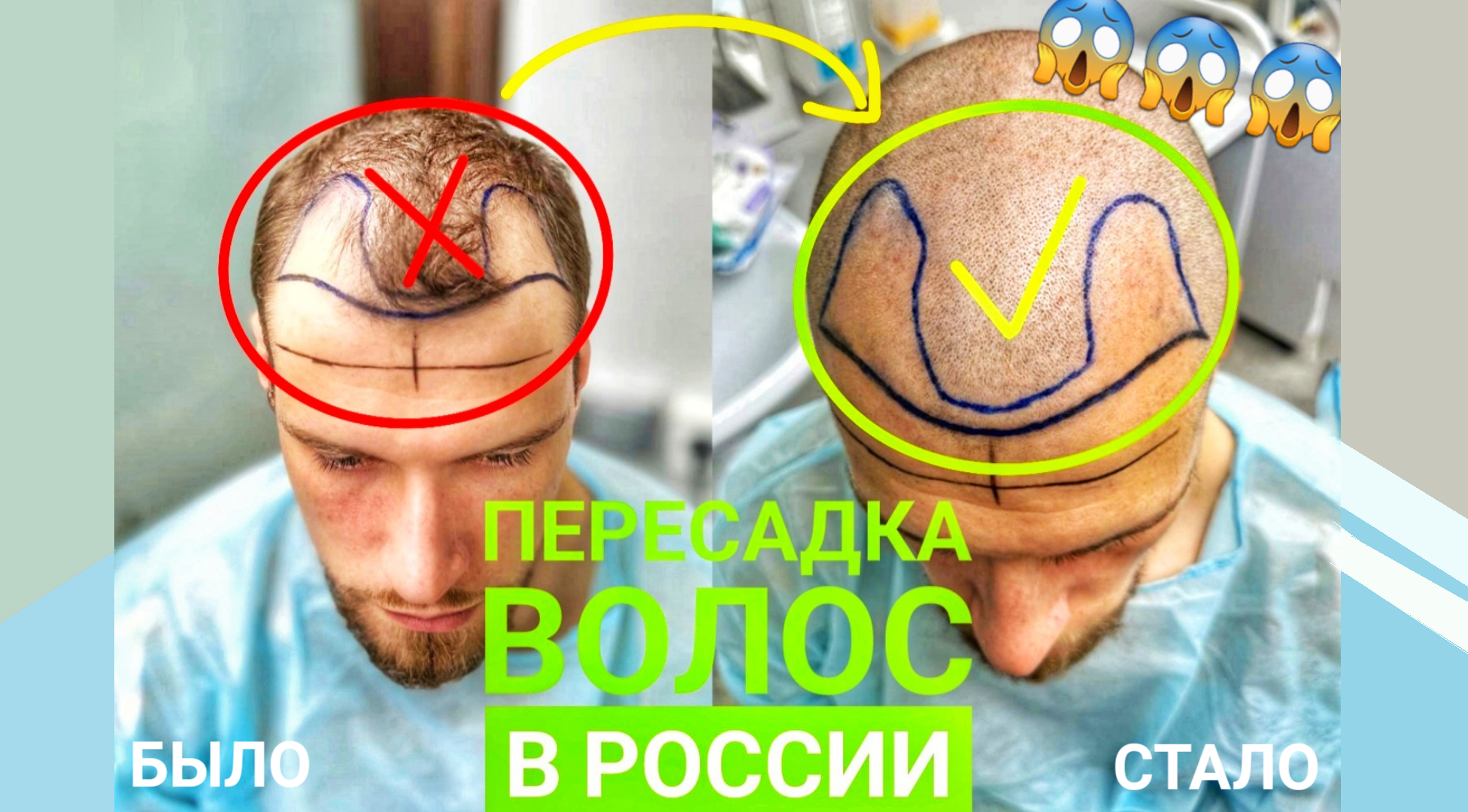 Пересадка волос в России. Блог #1 смотреть онлайн